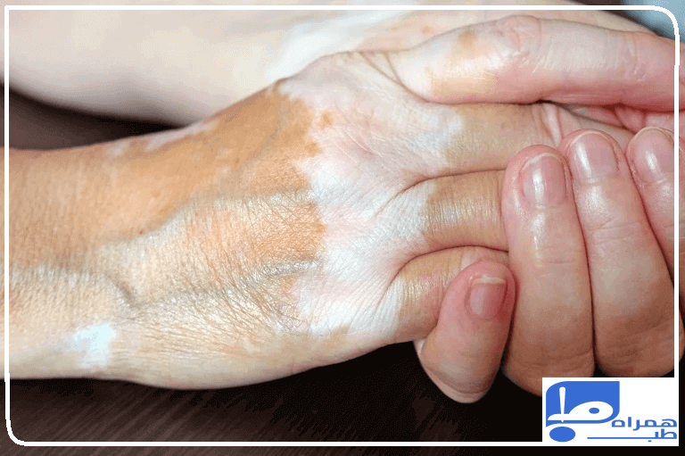 بیماری پیسی چیست؟ علائم، علل و درمان لکه‌های سفید روی پوست